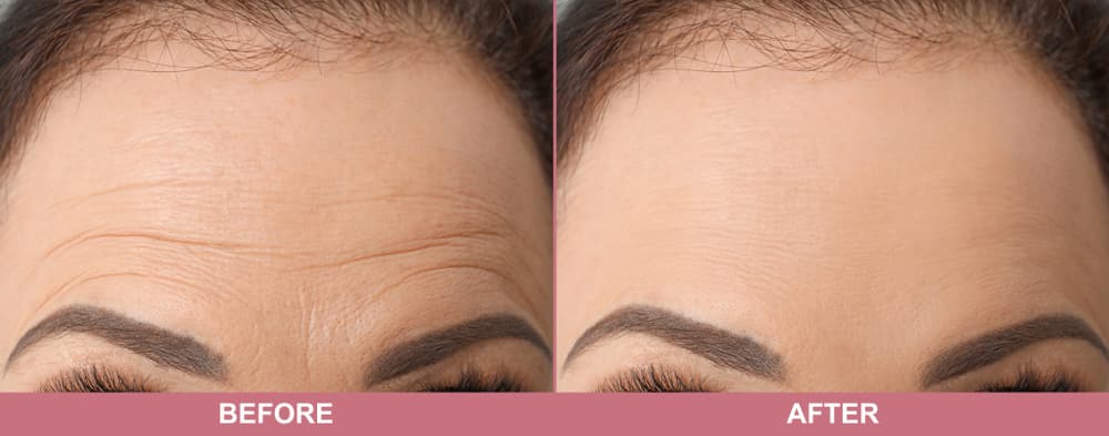 Forehead wrinkles before and after pictures