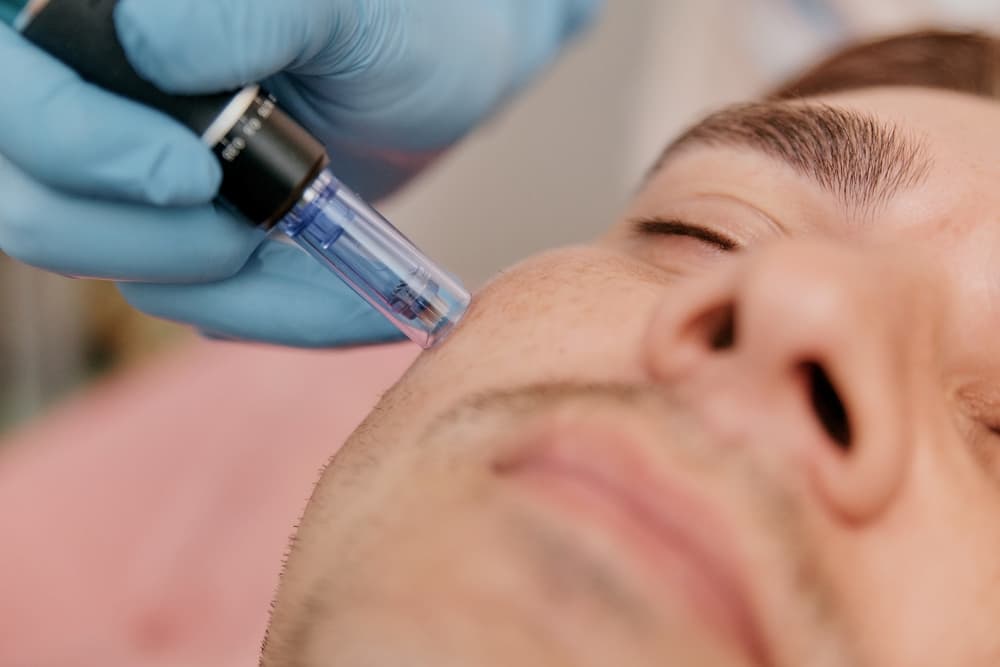 does microneedling get rid of acne scars