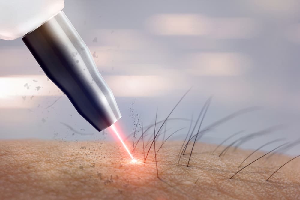 laser hair removal close up
